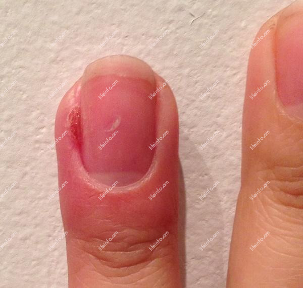 Պանարիցիում երեխաների մոտ Պանարիցիում երեխաների մոտ