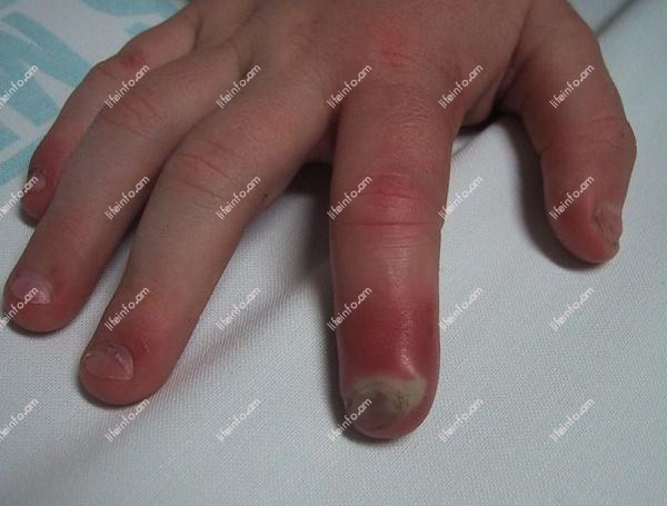 Բուժման կոնսերվատիվ մեթոդները Բուժման կոնսերվատիվ մեթոդները