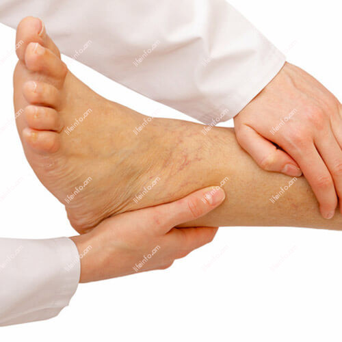 Թրոմբոֆլեբիտ Թրոմբոֆլեբիտ