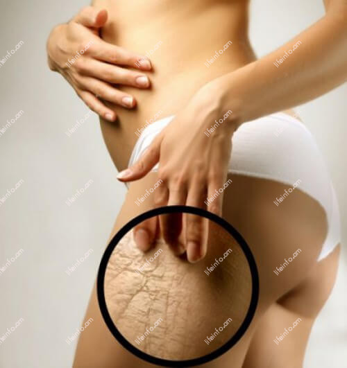 Խորը երակների թրոմբոզ Խորը երակների թրոմբոզ