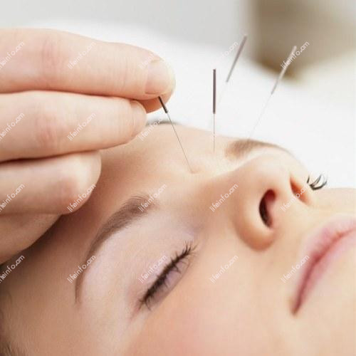 Ասեղաֆլեքսոթերապիա Ասեղաֆլեքսոթերապիա