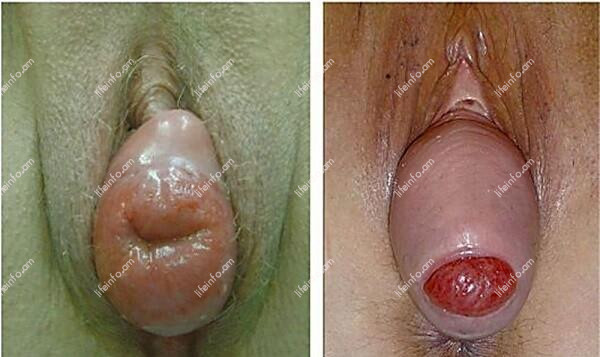 Տեղումները արգանդի Տեղումները արգանդի