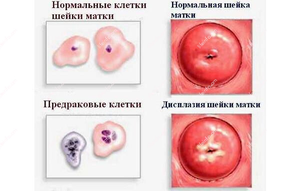 Արգանդի վզիկի դիսպլազիա Արգանդի վզիկի դիսպլազիա