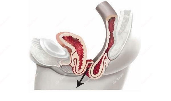 Արգանդի իջեցում Արգանդի իջեցում