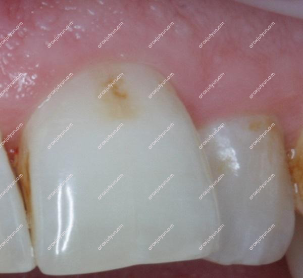 Կարիեսի բուժումը տնային պայմաններում Կարիեսի բուժումը տնային պայմաններում