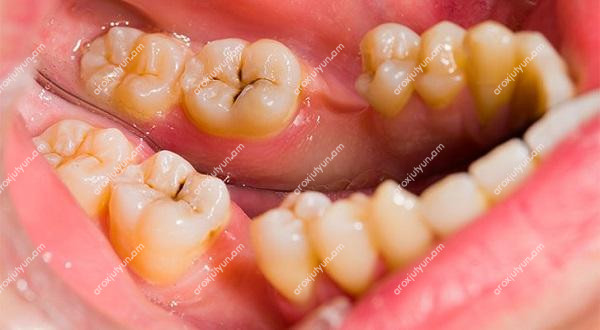 Կարիեսի տեսակները Կարիեսի տեսակները