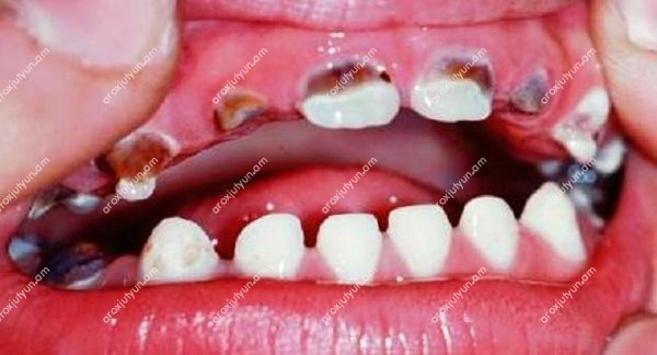 Կարիեսը հղիության ժամանակ Կարիեսը հղիության ժամանակ