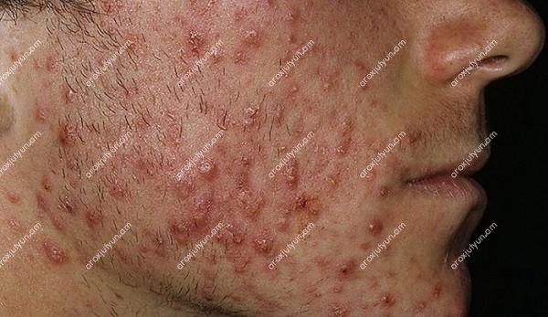 Ստերոիդային պզուկներ Ստերոիդային պզուկներ