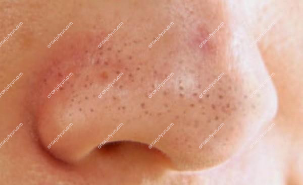 Վարդագույն պզուկներ (ռոզացեա)