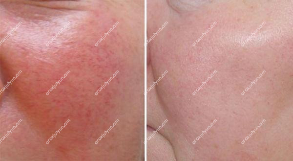 Սպիտակ պզուկներ (միլիում) Սպիտակ պզուկներ (միլիում)