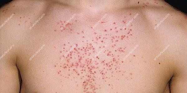 Սև պզուկներ (կոմեդոն) Սև պզուկներ (կոմեդոն)