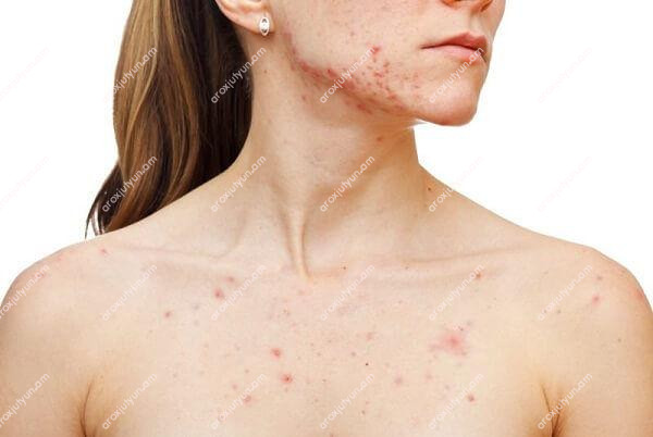 Ակնեի դասակարգումը ըստ ծանրության աստիճանի Ակնեի դասակարգումը ըստ ծանրության աստիճանի