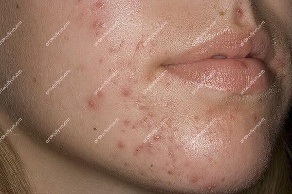 Ակնեի դեմ պայքարի տնային մեթոդները Ակնեի դեմ պայքարի տնային մեթոդները