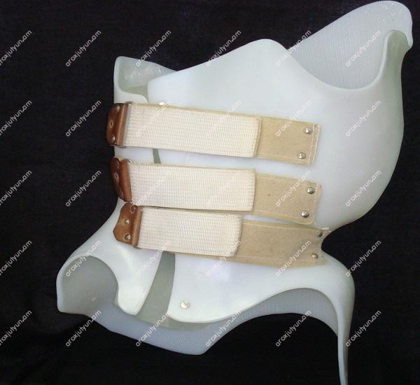 Ձախակողմյան սկոլիոզ Ձախակողմյան սկոլիոզ