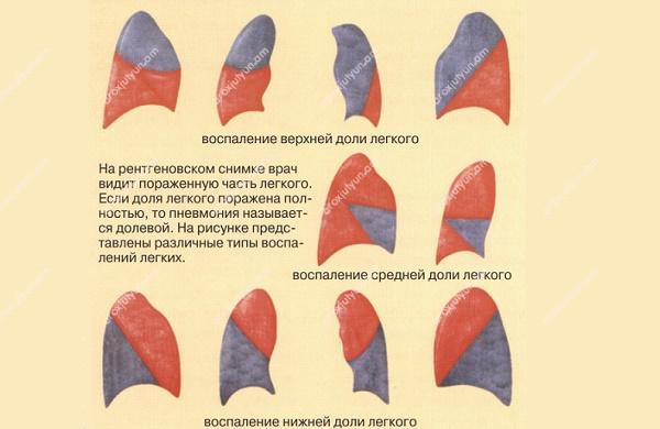 Թոքերի բորբոքման տեսակները