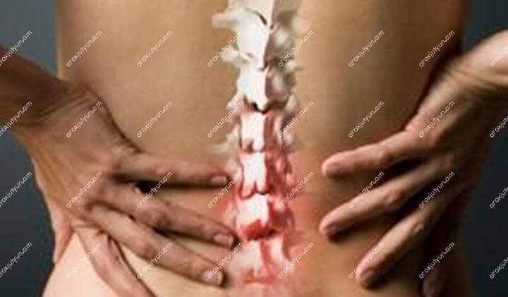 Սպոնդիլոլիստոզ Սպոնդիլոլիստոզ