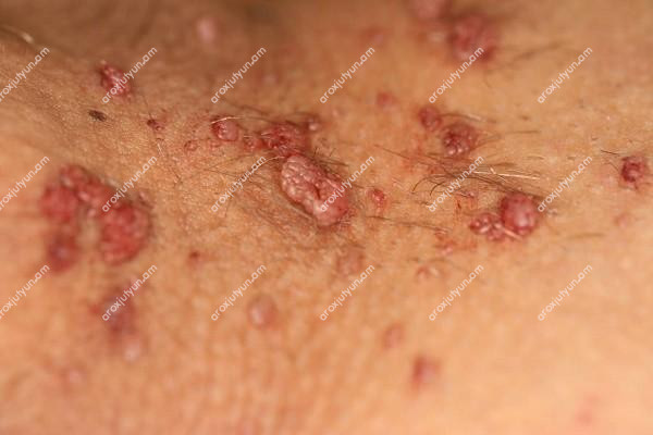 Վարակիչ Հիվանդություններ